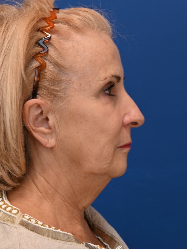 Renuvion Skin Resurfacing Before & After Image